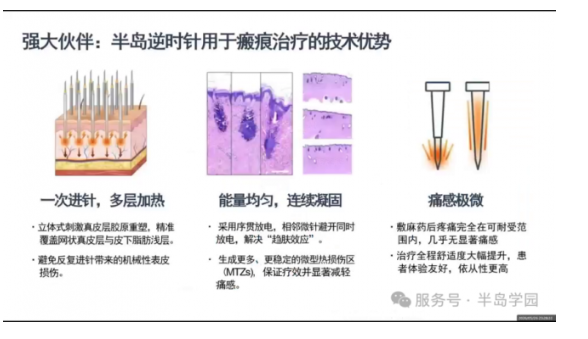 痘坑改善总不理想？半岛逆时针分型联合方案全解析